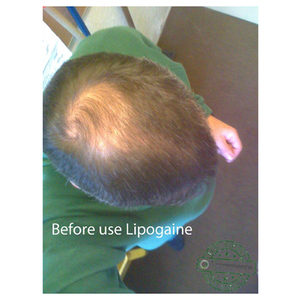 Lipogaine Intensive Treatment Complete Solution for Thinning Hair
