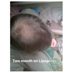 Lipogaine Intensive Treatment Complete Solution for Thinning Hair