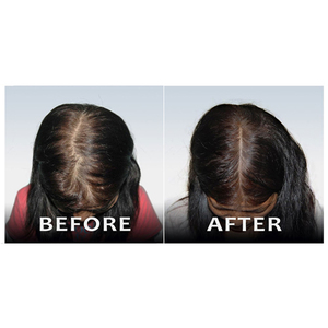 Rogaine Women's Hair Regrowth Treatment