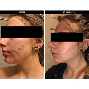 DRMTLGY Tri-Active Acne Pads
